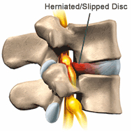 Herniated Slipped Disc - Cause of Back Pain