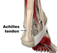 Achilles Tendinopathy