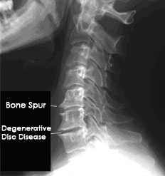 Cervical Spondylosis