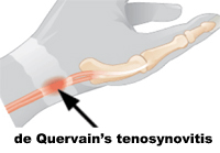 deQuervain's Tenosynovitis