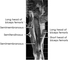 Hamstring Injuries