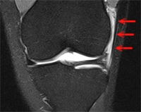 Iliotibial Band Friction Syndrome