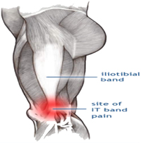 Iliotibial Band Friction Syndrome