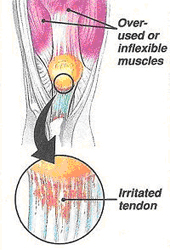 Patella Tendonosis