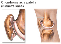 Runner's Knee - Patellofemoral Syndrome