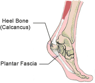 Heel Spurs - Plantar Fasciitis