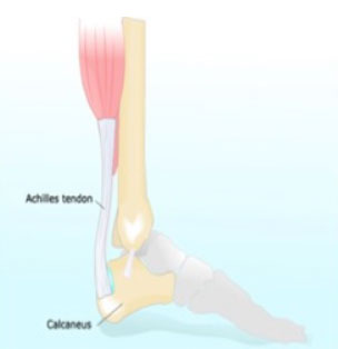 Sever's Disease