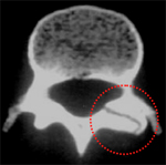 Stress Fracture Lumbar Spine