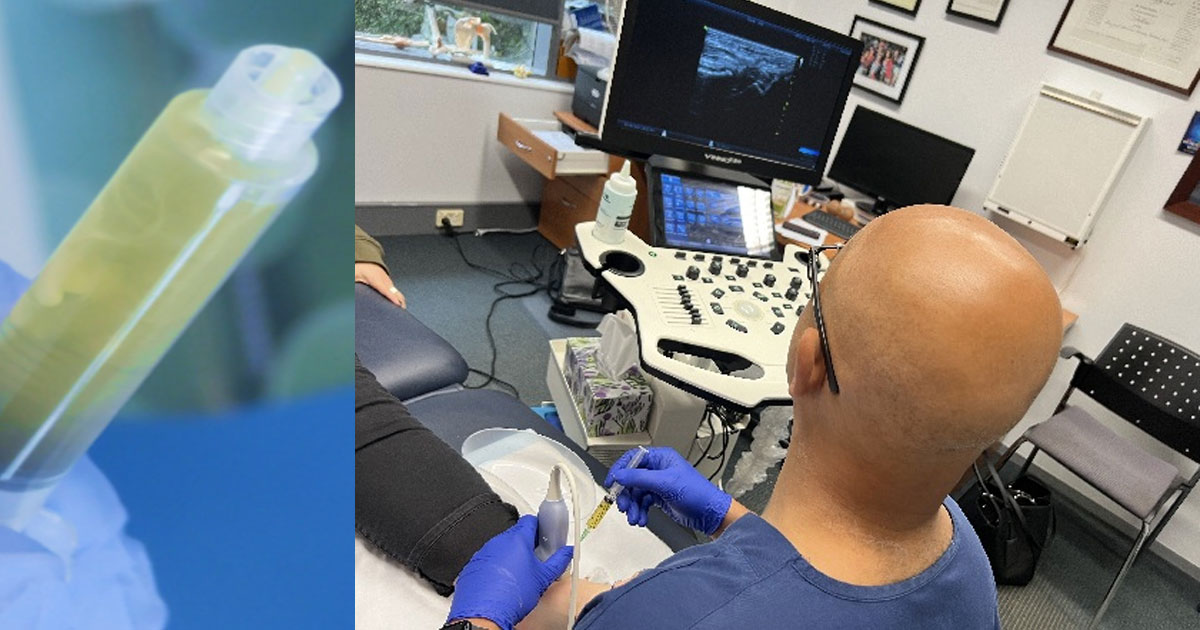 Across recent syntheses and expert reviews, higher total platelet numbers delivered to the joint are associated with better clinical outcomes, particularly for function and durability of effect.