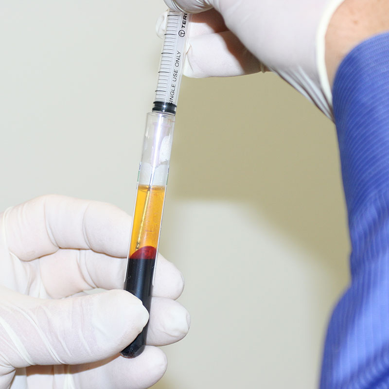 Platelet Rich Plasma Injections Sydney Sports Medicine Centre Platelet Rich Plasma Injections