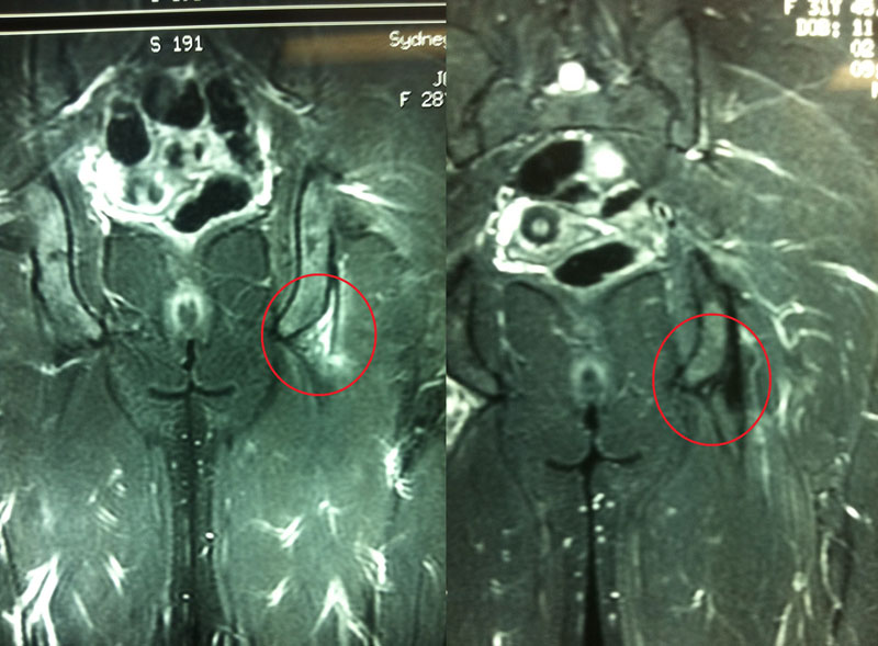 Hamstring tear treated with PRP injection